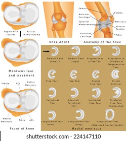 Human Knee Joint. Anatomy Of The Knee. Menisci Of The Knee. Medial Meniscus. Lateral Meniscus. Meniscus Tear And Surgery