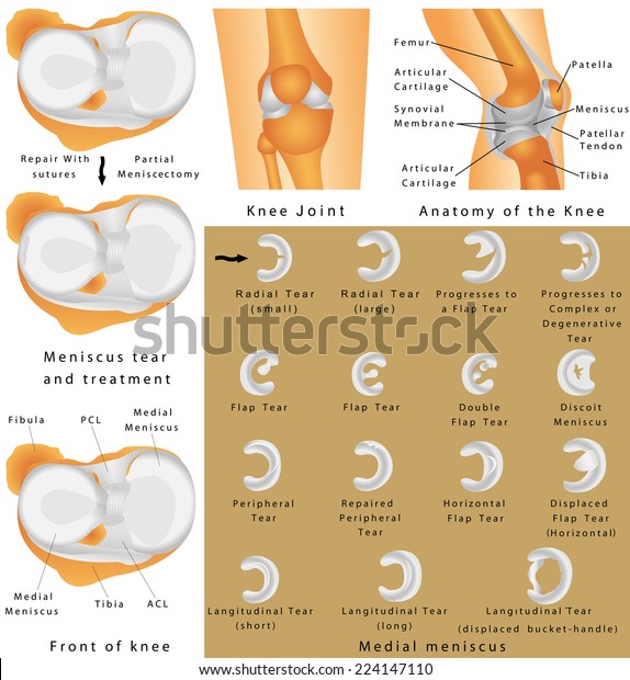 Human Knee Joint. Anatomy of the Knee. Menisci of\
the knee. Medial meniscus. Lateral meniscus. Meniscus tear and\
surgery