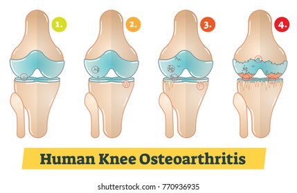 Human Knee Osteoarthritis Vector Diagram Illustration