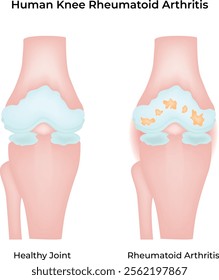 Human Knee Rheumatoid Arthritis Science Design Vector Illustration Diagram