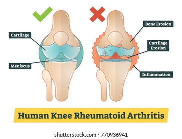 Human Knee Rheumatoid Arthritis Vector Diagram Illustration