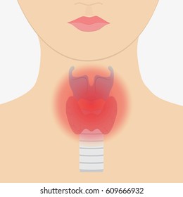 Human larynx illness. Flat vector stock illustration