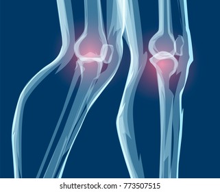 Human leg bones, x-rays. Mecial vector illustration.