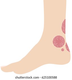 Human leg with psoriasis illustration