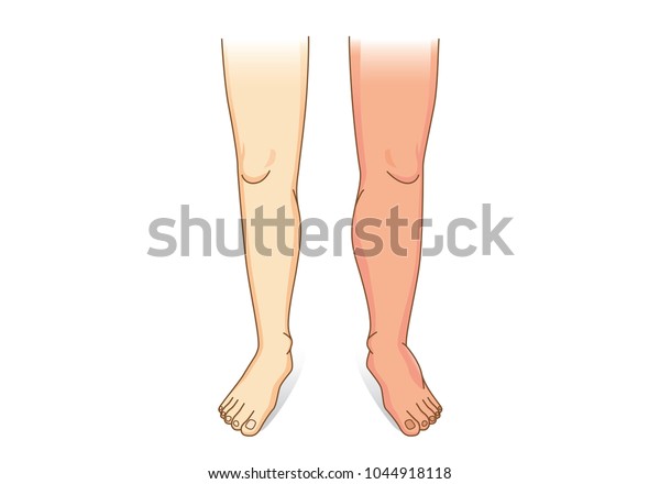 正面図で腫れ上がる人間の脚 体液の病気や状態を示すイラストが足と足で集まります のベクター画像素材 ロイヤリティフリー