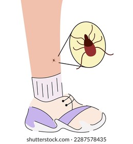 The human leg with  the tick bite. Tick bite leg.Tick bite.  Healthcare illustration. 