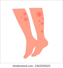 Human legs covered with red rash. Feet with allergic reaction, skin irritation flat vector illustration