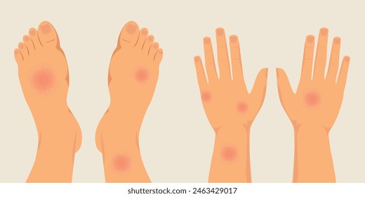 Human legs and hands covered with red rash. Feet with allergic reaction, skin irritation, medical and healthcare, vector illustration.