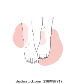 Human legs with skin allergy. Feet covered with red rash, atopic dermatitis line vector illustration