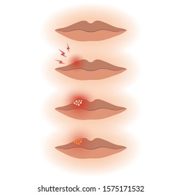 Human lips with herpes stages, treatment of viral infection