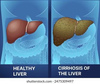 Human liver disease. Healthy liver, cirrhosis of the liver. Healthcare illustration. Vector illustration.