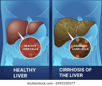 Human liver disease. Healthy liver, cirrhosis of the liver. Healthcare illustration. Vector illustration.