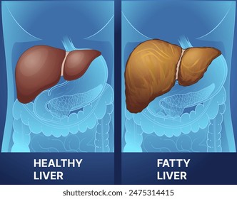 Enfermedad del hígado humano. Hígado sano, hígado graso. Ilustración sanitaria. Ilustración vectorial.