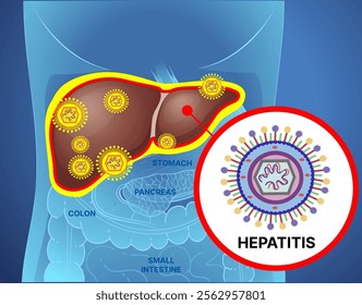 Human liver disease. Hepatitis. Medical illustration. Vector illustration. 