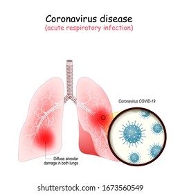Human lungs are attacked by coronavirus (middle East respiratory syndrome). COVID-19 that causing pneumonia. Lungs infected with coronavirus. vector illustration. MERS-Cov. Novel coronavirus.