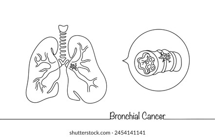 Human lungs with bronchi affected by cancer. An oncological disease that develops from the bronchial glands and epithelium that covers the respiratory tract. Medical illustration with line.