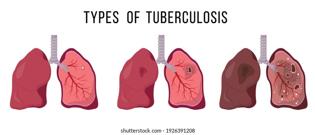 Human lungs infected Mycobacterium tuberculosis. Latent infection. Cavitary tuberculosis. Miliary tuberculosis. Medical concept. Lung disease illustration on white background.