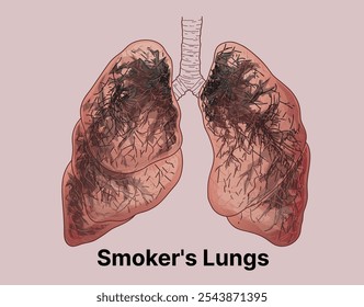 Menschliche Lungen, ein Teil der Atemwege. Raucherlunge. Beschädigte menschliche Lungen. Illustration zum Thema Gesundheitswesen, Illustration zur Bildung.  Vektorgrafik.
