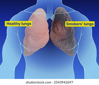Pulmões humanos, uma parte do sistema respiratório. Pulmões saudáveis. Fumantes e pulmões. Pulmões humanos danificados. Ilustração da área de saúde, ilustração educacional.  Ilustração vetorial.
