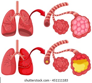 Human lungs with pneumonia illustration