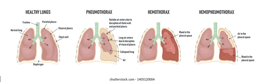 Chest Tube Pneumothorax Diagram