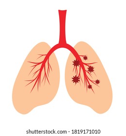 Human lungs, schematic color illustration of human lungs infection with a virus. Anatomical structure of the human respiratory system. Virus trapped in the lungs, influenza coronavirus - Shutterstock ID 1819171010