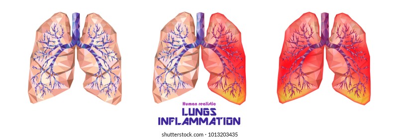 Human lungs and trachea set in low poly. Healthy, one lung ill, sick lungs. Pneumonia inflammation, tuberculosis, cancer. Vector.