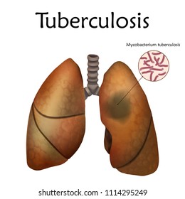Human lungs. Tuberculosis. Anatomy vector illustration. White background.