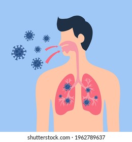 Menschliche Lungen mit Viruszellen in flachem Design. Morbus Coronavirus Pneumonie. Anatomie Infektion der Atemwege.