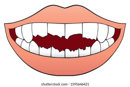 A human mouth displaying several badly broken teeth