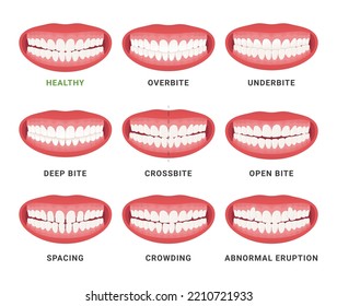 Human mouth jaws medical bad bite and healthy scheme with names set vector flat illustration. Orthodontist anatomical surgery correction dentistry disease overbite underbite crossbite spacing