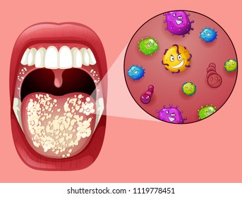 Human Mouth With Oral Thrush Illustration