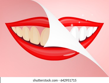 Human mouth with white teeth, before and after. Beauty and dental health concept. Vector illustration on pink background.