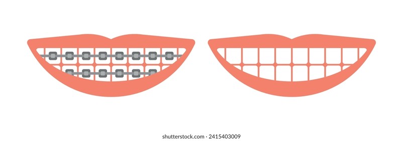 Human mouth with and without braces beautiful smile vector illustration.