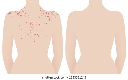 Human neck and back with psoriasis and healthy without it