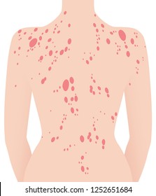 Human neck and back with psoriasis illustration