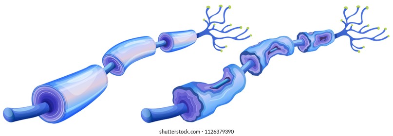 Human Nerves Cell and Peripheral Neuropathy illustration