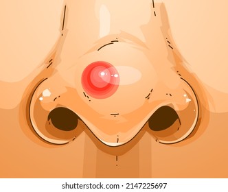 A human nose with a pimple. Skin problems. Medical illustration. Healthcare illustration. Vector illustration.