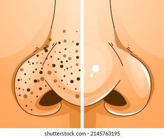 The human nose with skin problems. Blackheads. Before, after illustration. Healthcare illustration. Vector illustration.