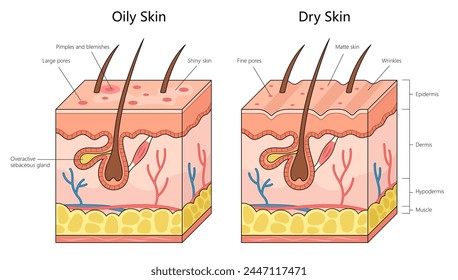 Piel grasa humana con piel seca, diferencias en la actividad de las glándulas sebáceas, tamaño de los poros y diagrama de estructura de la textura de la piel Ilustración vectorial esquemática dibujada a mano. Ilustración educativa de ciencias médicas