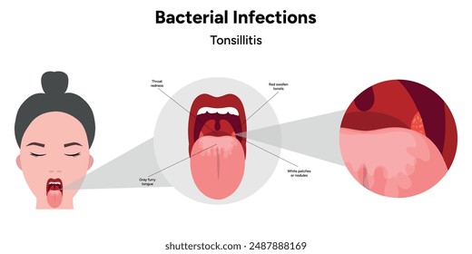 Human with open mouth and tonsillitis in zoom