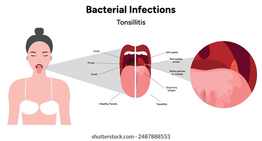 Human with open mouth and tonsillitis in zoom bacterial infections 