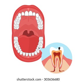 human oral cavity illustration on the white background. Moth anatomy. dental caries, toothache, bad teeth. diseased tooth in the oral cavity illustration