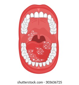 Human Oral Cavity Illustration On The White Background. Moth Anatomy. Oral Thrush. Diseases Of The Mouth, Tongue Disease, Teeth Disease. 