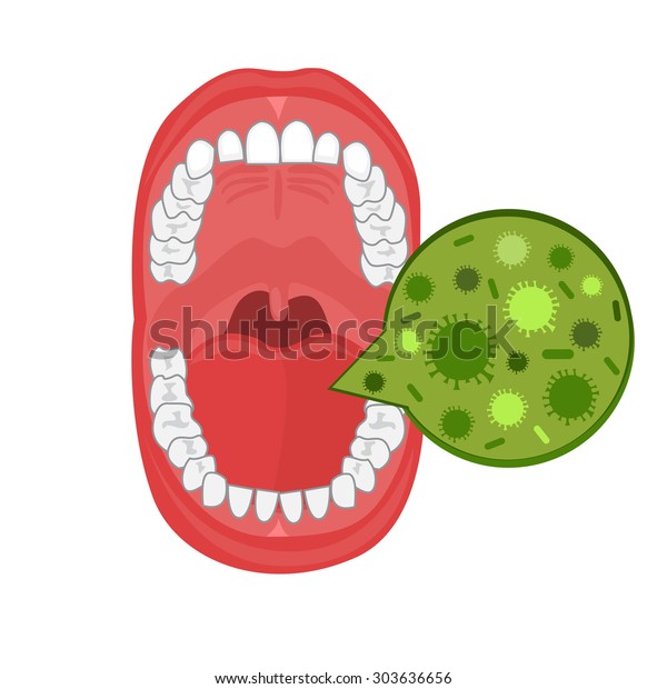白い背景に人間の口腔イラスト 蛾の解剖学 口の中の感染症例 のベクター画像素材 ロイヤリティフリー 303636656