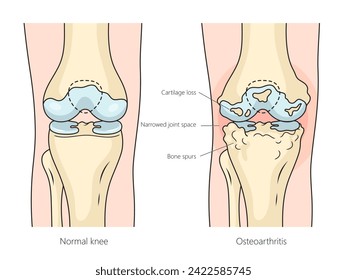 Osteoartritis Humana Artritis reumatoide de la estructura articulatoria de la rodilla diagrama de la ilustración esquemática del vector dibujada a mano. Ilustración de la ciencia médica