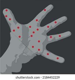 Enfermedad de la palma humana. Monkeypox. Tema de noticias.