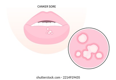 Human Papilloma of HIV and AIDS bacterial fungal Viral canker sore lip swollen with Behcet’s or Crohn's disease papillomavirus Immune Celiac disorder Inflammatory