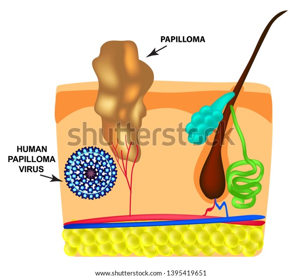 papillomas causes