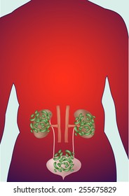 Human patients with bacterial kidney Vector.